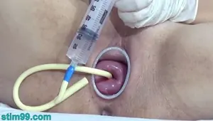 Japanese Cervix Stretching with Catheter Inflation Uterus